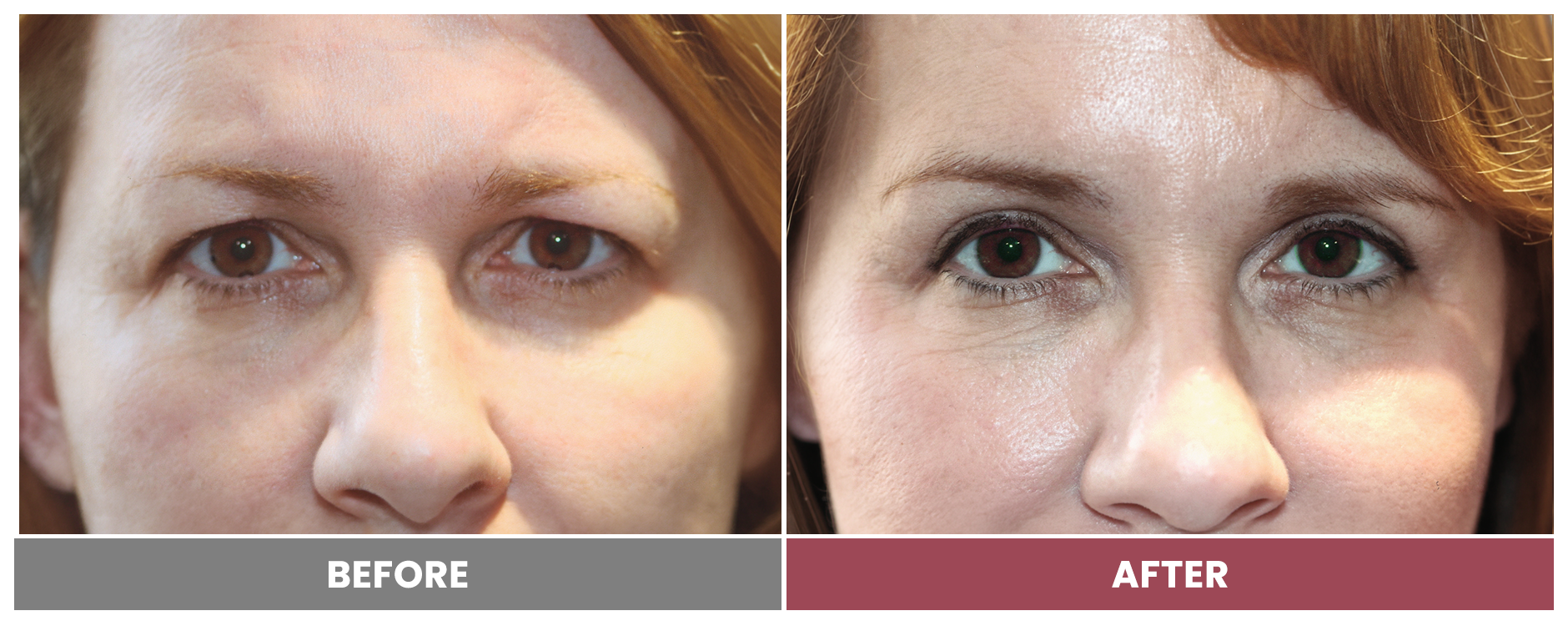 Upper Blepharoplasty - Case 55